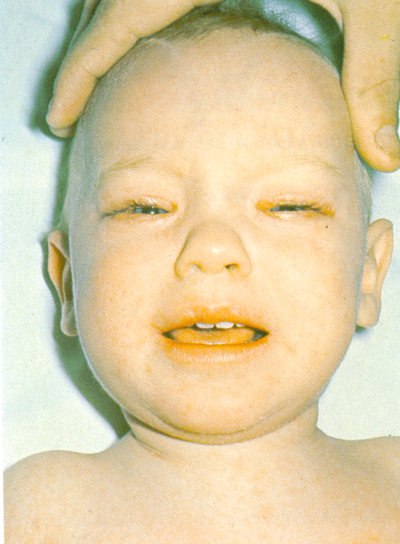 Bebê com sintomas do Sarampo