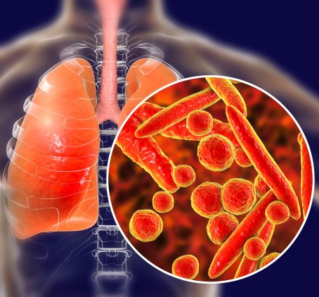 Pneumonia: Sintomas, Tipos E Como é O Tratamento | Vacinas.com.br