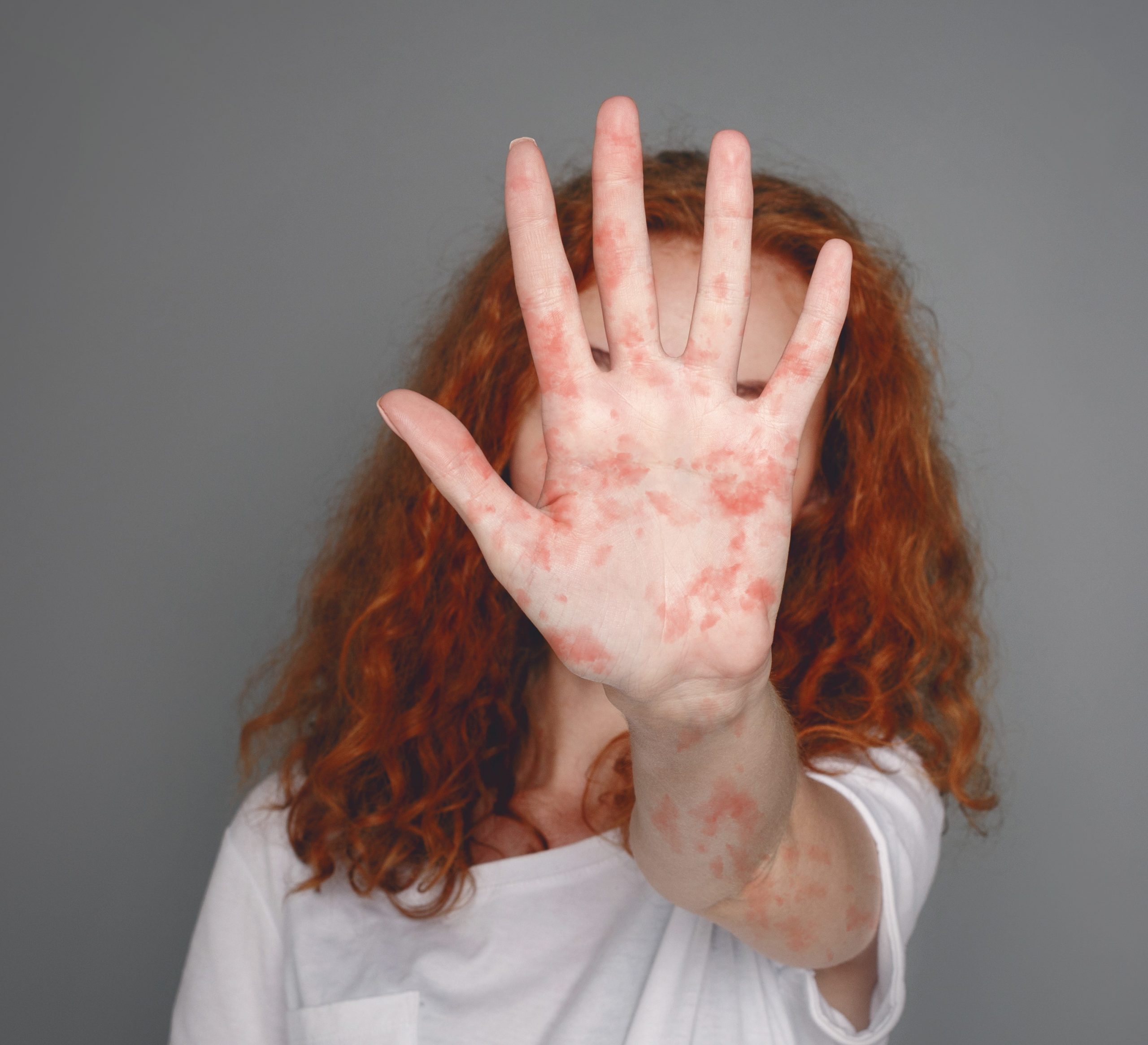Mulher mostrando a mão com sarampo